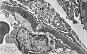 M,29y. | type II membranoproliferative glomerulonephritis (dense deposit disease) M,29y. | type II membranoproliferative glomerulonephritis (dense deposit disease)